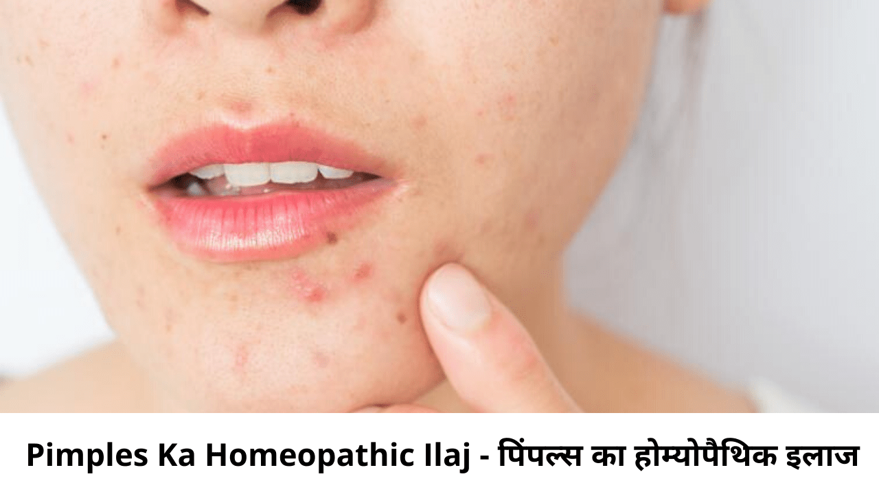 Pimples Ka Homeopathic Ilaj