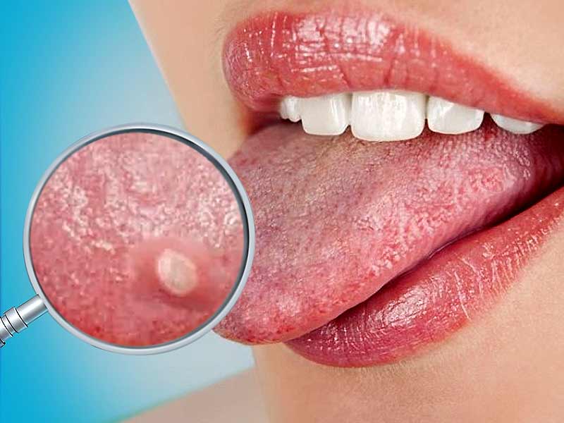 mouth ulcer medicine name