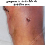 gangrene in hindi